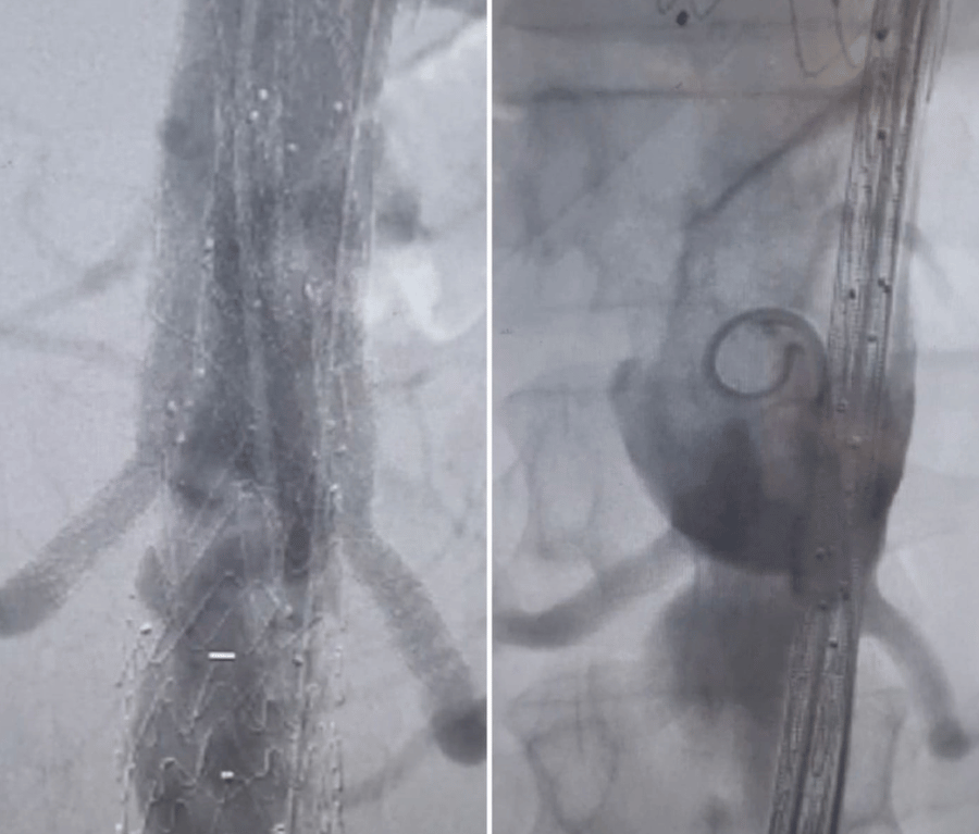 Aortic Aneurysm repair