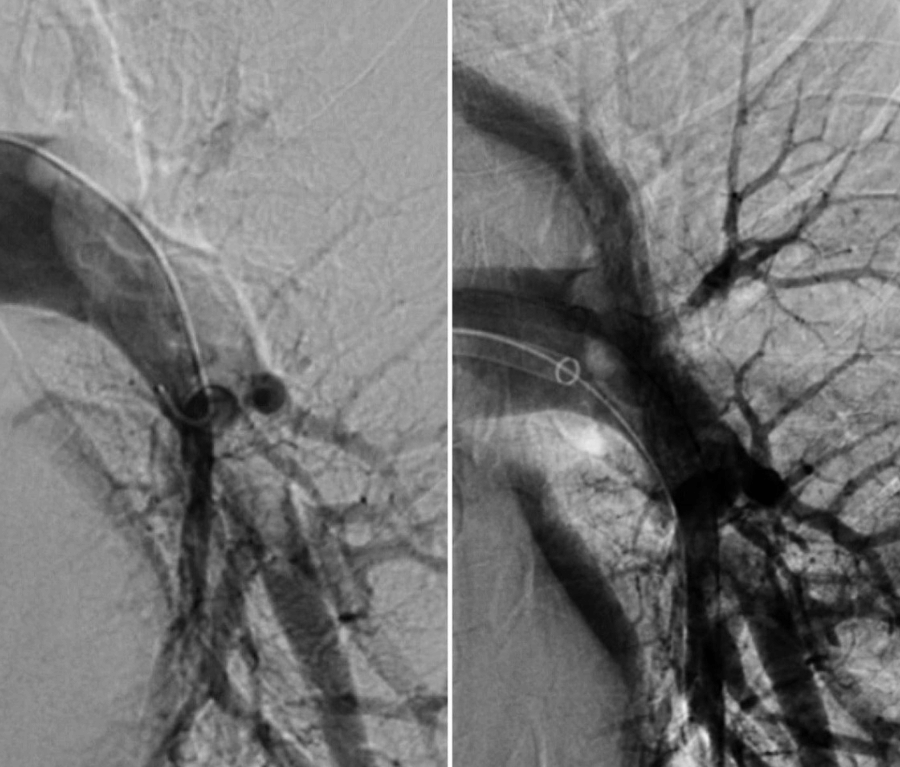 Deep Vein Thrombosis