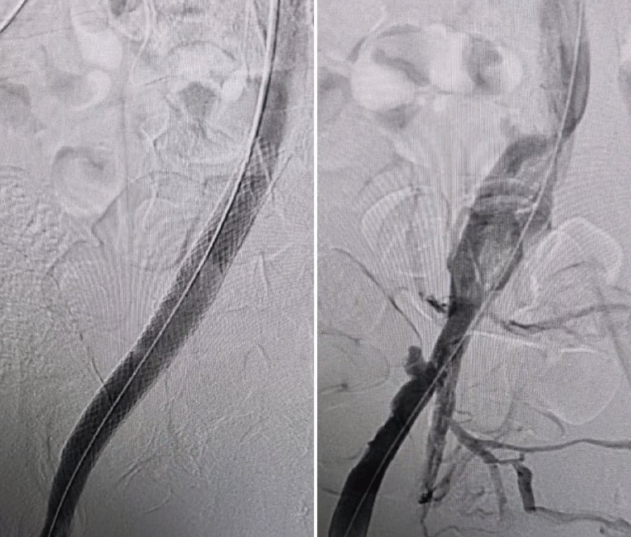 Deep Vein Thrombosis