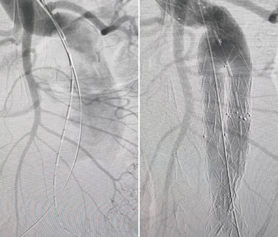 Aortic Aneurysm repair