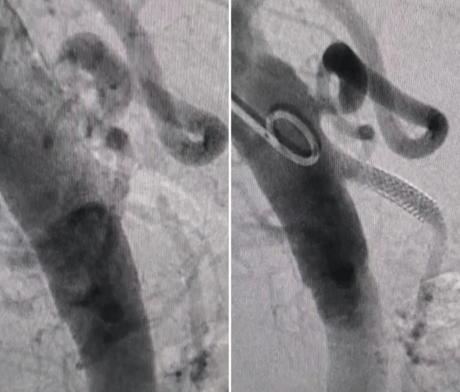 Mesenteric Artery Disease