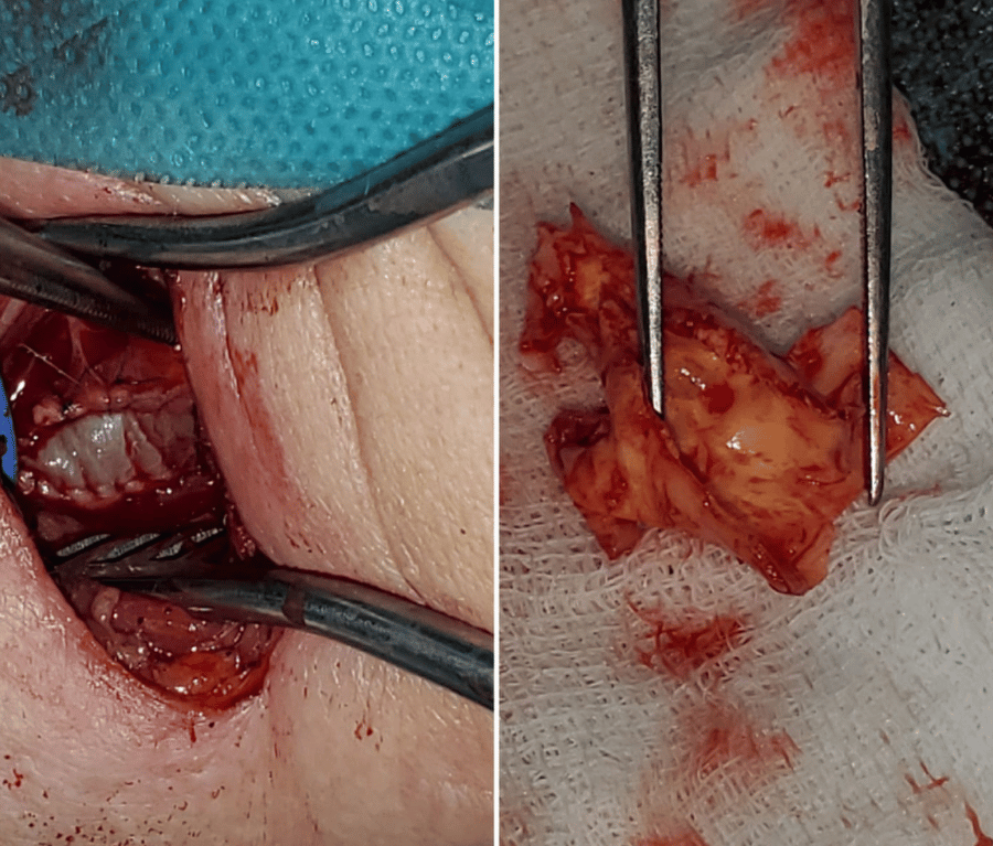 Carotid Artery Disease